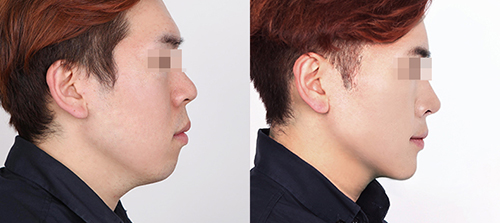 韩国菲斯莱茵整形医院男性面部吸脂案例