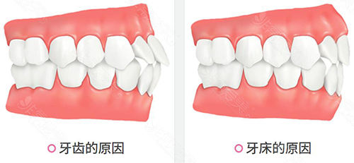 凸嘴形成的原因