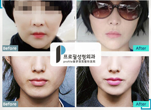 韩国普罗菲耳Profile面部提升除皱效果图