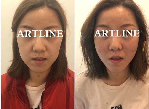韩国altline埋线提升除皱术后即刻效果图