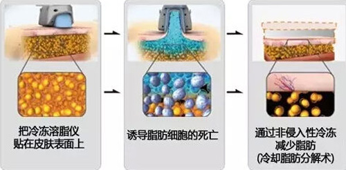 冷冻溶脂原理图 冷冻溶脂原理图