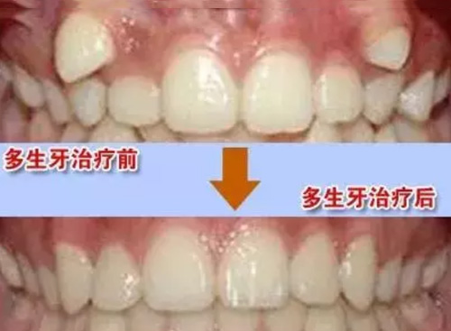 多生牙案例对比