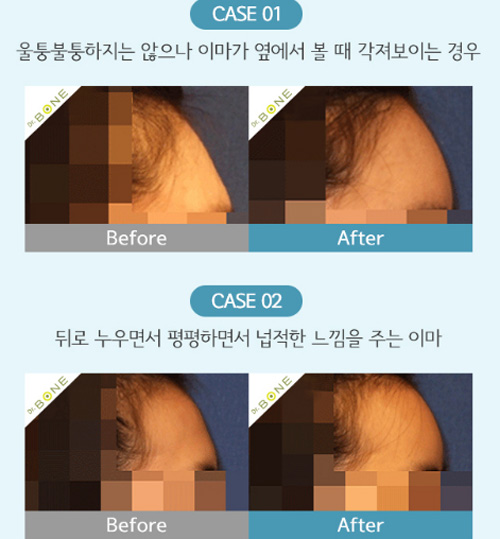 韩国bonps整形外科额头填充前后对比图