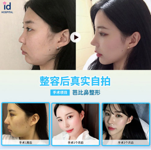 韩国ID整形医院鼻综合手术案例