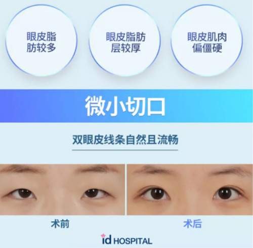 韩国ID整形医院双眼皮手术案例
