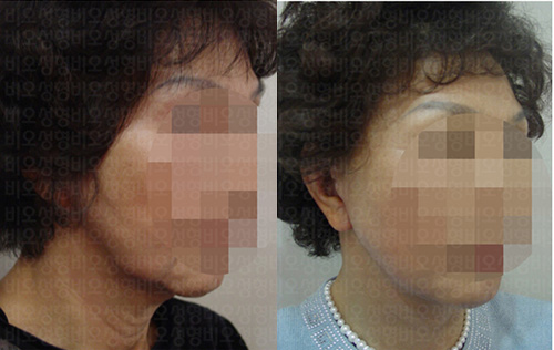 韩国BIO整形拉皮手术前后对比