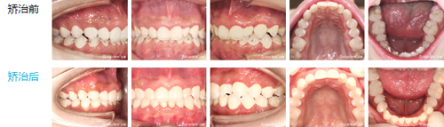 正雅隐形矫正案例对比照