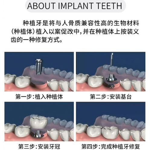 种植牙的过程