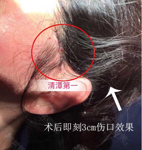 韩国清潭First小切口提升伤口位置 韩国清潭First小切口提升伤口位置