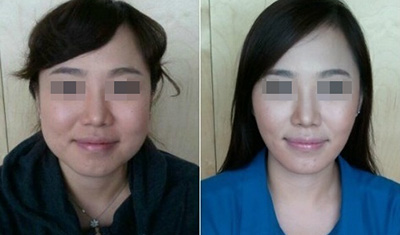 韩国面部吸脂手术前后对比效果