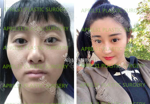 韩国4月31日整形外科鼻整形案例
