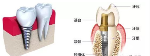 种植牙图片