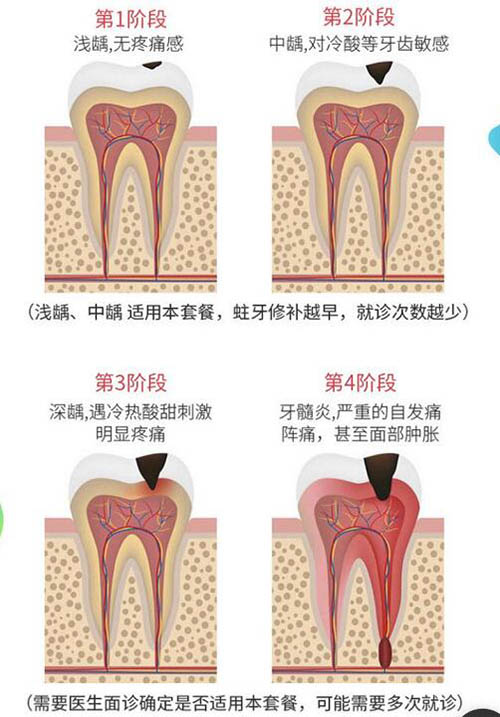 龋齿的四个阶段