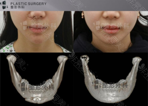 韩国下颌角修复手术改善前后照片