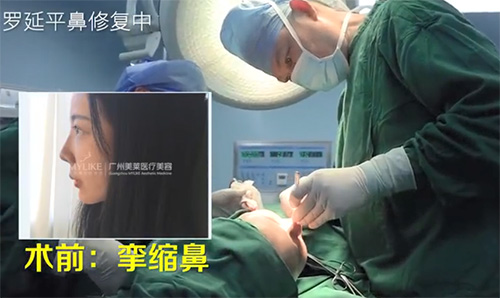 罗延平做鼻子手术过程图