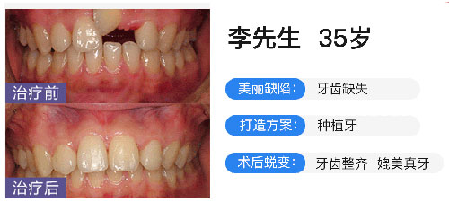 深圳鹏程医院口腔科孙海鹏医生种植牙<span style=