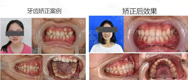 中山口碑好的口腔医院中,好民生牙齿矫正疗效、费用怎样？