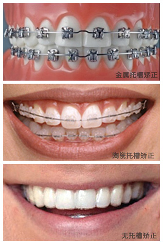 牙齿矫正方法对比