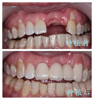 广州圣贝口腔医院种植牙案例