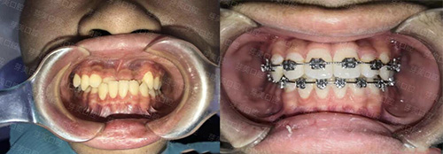 哈爾濱芽美口腔矯正對比
