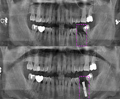 长春超龙牙博士口腔种植牙前后对比