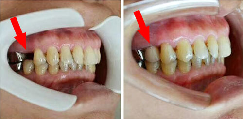 武汉五洲口腔医院种植牙前后对比照片
