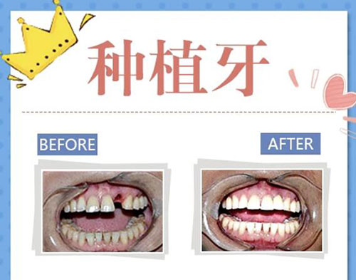 西安诺贝尔牙科种植牙改善