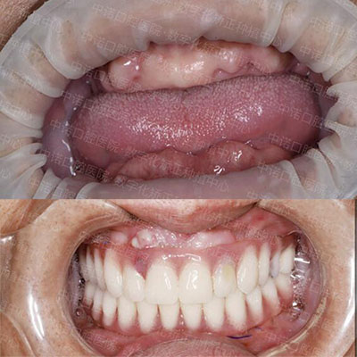 西安中诺口腔全口种植牙改善