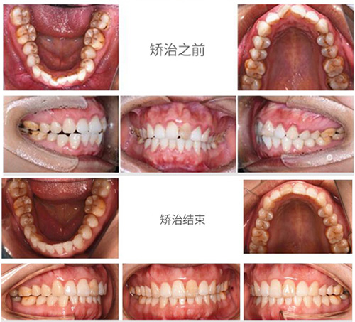 深圳世纪河山口腔医院牙齿矫正对比照片