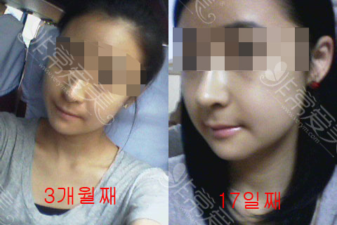 术后3个月效果 术后3个月效果
