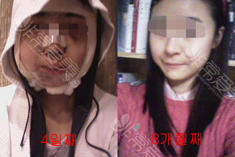 术后4天状态和后期恢复对比 术后4天状态和后期恢复对比