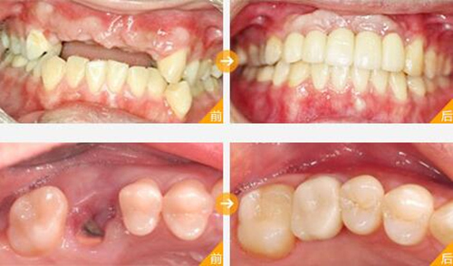 宁波种植牙哪里好