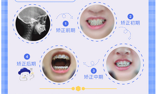 深圳牙齿矫正价格对比，隐形矫正哪家医院技术好还便宜？