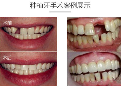 北京圣贝口腔种植牙对比
