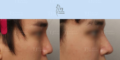 韩国TJ整形外科隆鼻案例图
