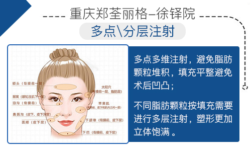 重庆郑荃丽格(徐铎院)自体脂肪全脸填充怎么样 多少钱