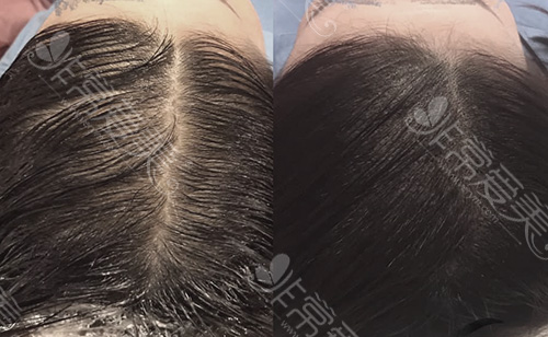 女性植发前后头发密度改善