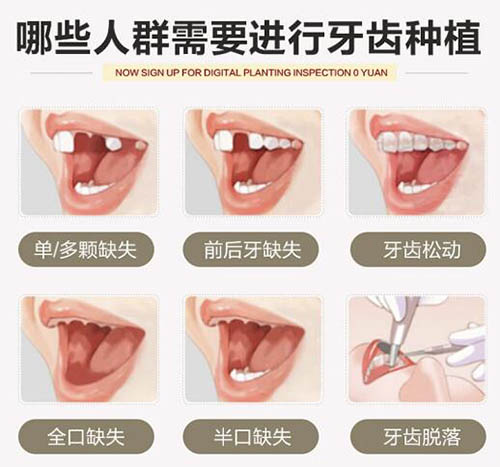 哪些人群需要進行種植牙改善