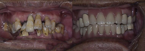 北京合众齿科种植牙改善
