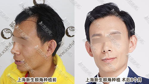 上海新生额角植发术后8个月对比照片