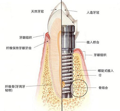 莆田种植牙哪里比较好,公布种牙价格表揭秘植体多少钱一颗!