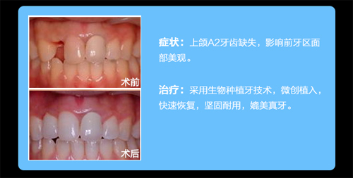 成都博爱口腔医院种植牙对比