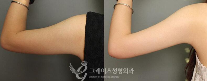 韩国格瑞丝整形外科手臂吸脂前后对比照片