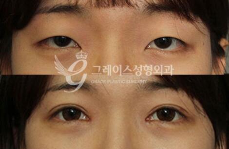 韩国格瑞丝整形外科眼部整形前后对比照片