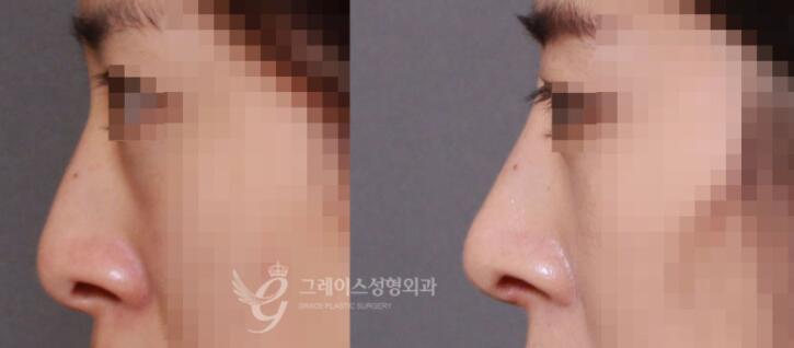韩国格瑞丝整形外科鼻部矫正前后对比照片