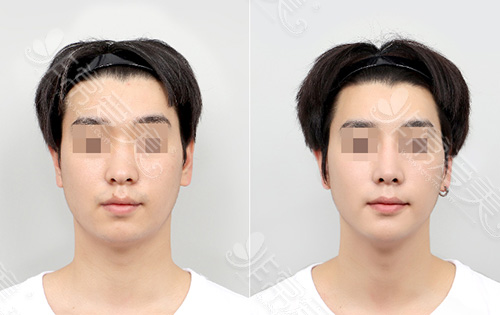 男性面部轮廓手术效果