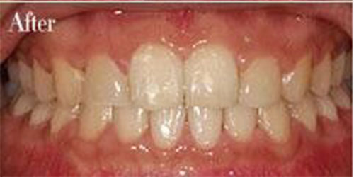 深圳弘和医院的隐形牙齿矫正的术后案例