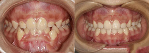 济南瑞泰口腔牙齿矫正对比照片