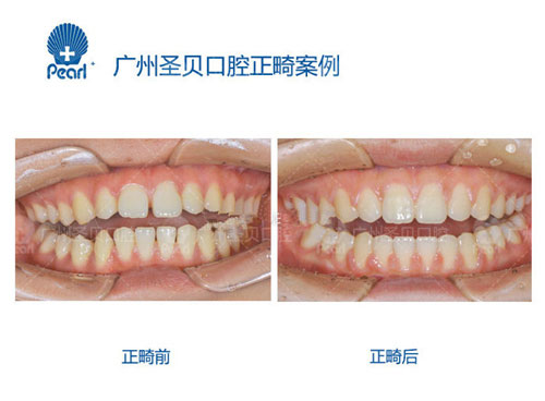 牙齿矫正是个坑？广州哪个口腔医院正畸便宜又好？