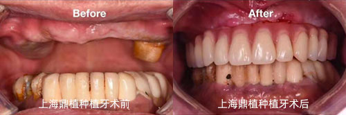 上海鼎植口腔医院全口种植牙对比照